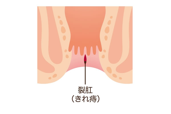 切れ痔（裂肛）